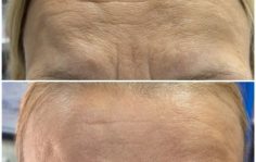 Франшиза HAPPY SKIN: Безинъекционное омоложение