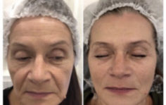 Франшиза WOW BEAUTY: Инвазивная косметология