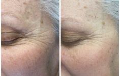 Франшиза HAPPY SKIN: Безинъекционное омоложение