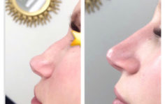 Франшиза WOW BEAUTY: Инвазивная косметология