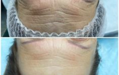 Франшиза HAPPY SKIN: Безинъекционное омоложение