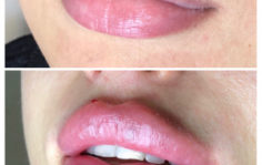Франшиза WOW BEAUTY: Инвазивная косметология