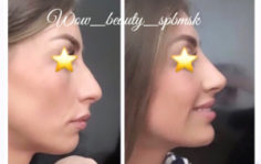 Франшиза WOW BEAUTY: Инвазивная косметология