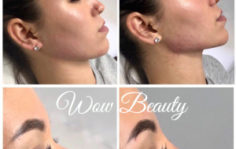Франшиза WOW BEAUTY: Инвазивная косметология