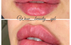 Франшиза WOW BEAUTY: Инвазивная косметология