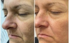 Франшиза HAPPY SKIN: Безинъекционное омоложение