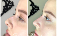 Франшиза WOW BEAUTY: Инвазивная косметология